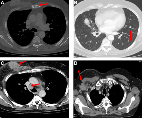 Figure 8 First CT scan evaluation. (A) Red arrows in the figures show sternum lytic metastasis, (B) lung metastasis of 30 mm diameter, (C) mediastinal lymph node of 30 mm diameter and right breast tumor, and (D) axillary lymph node.