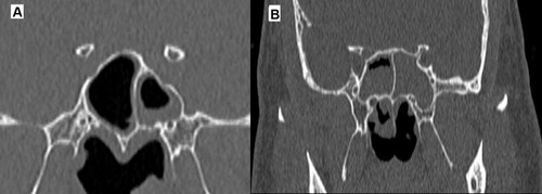 Figure 5 Comparison of sphenoid sinus CCAD (A) vs nonCCAD (B) features. Scale bar, 1 cm is equal to 5 cm.