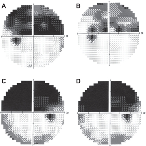 Figure 2 Change of visual fields after TES. (A, B) Visual fields of Case 2. Change of visual fields in a longstanding case before (A) and one month after (B) TES. The superior visual field defect is decreased. (C, D) Visual fields of Case 3. The change of the visual field in a fresh case before (C) and one month after (D) TES. The visual field defect is unchanged after TES.