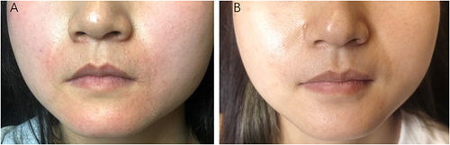 Figure 1 The skin lesions before and after abrocitinib therapy. (A) The skin lesions on the perioral region; (B) Two weeks after the abrocitinib therapy.