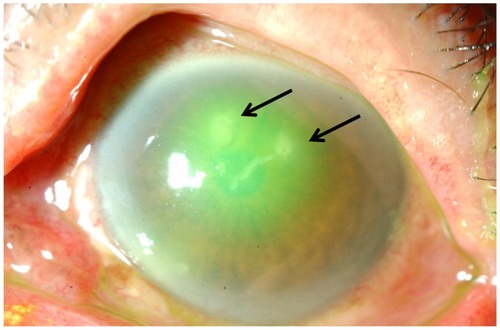 Figure 2 The corneal epithelial defect has become smaller, but it is complicated by infection (arrows) in the left eye.