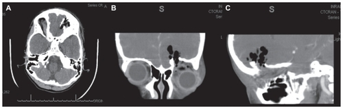 Figure 1 CT scan of skull axial (A), coronal (B), and sagittal (C) of the head showing a fracture of the orbital roof and speck of pneumocephalus, however no foreign bodies can be verified in this case involving wood fragment on CT examination.
