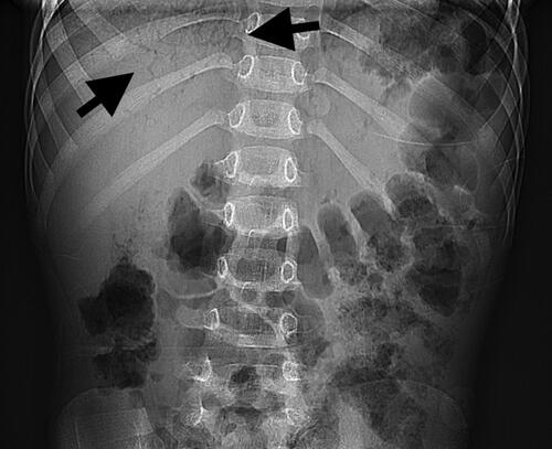 Figure 1. Abdominal radiograph. Upright radiograph demonstrates branching lucencies (arrows) in the right upper quadrant, compatible with portal venous gas.