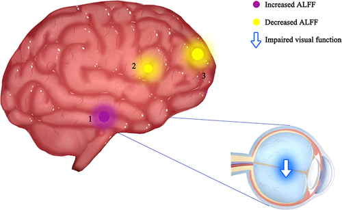Figure 5 The ALFF results of brain activity in the DON group.