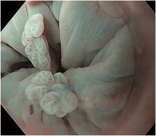 Figure 6. ASIL with a non-villous exophytic appearance.