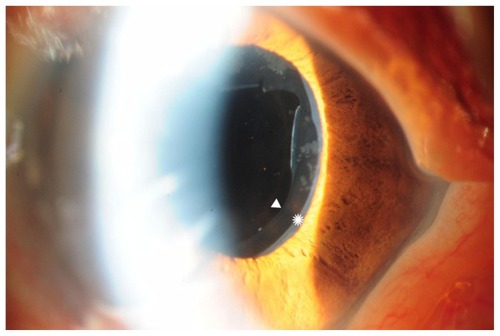 Figure 1A Double-ring sign seen at nasal edge of anterior lens capsule.