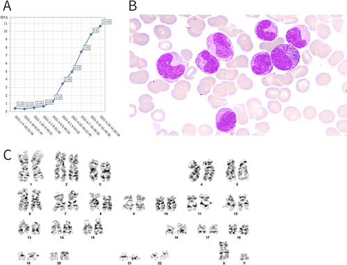 Figure 4 (A) Progressive increase in absolute monocyte count, (B) bone marrow cytology: significant increase in immature monocytes, (C) Karyotype:46, XY, t (11:19) (q23;p13)[19]/46, XY[1].