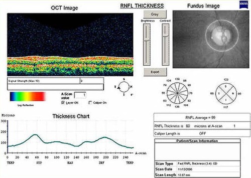 Figure 1 The retinal nerve fiber layer (RNFL) thickness analysis of a 48-year-old normal male from the Stratus optical coherence tomography (OCT). Video image of optic disc (top right), RNFL normative database map (middle right), and RNFL profile (top left). The Stratus OCT did not indicate an abnormal classification based on a normative database map (middle right versus down left).