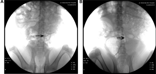 Figure 4 Representative abdominal X-ray films of the poly(ε-caprolactone) (PCL)/poly(lactide-co-glycolide) (PLGA) stent-implanted animals (A) at 14 days after insertion with no change in length, and (B) at 42 days with degradation of more than 50% in length. Arrow indicates PCL/PLGA stent.