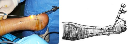 Figure 3 The placement of the arthroscope from distal medial incision.