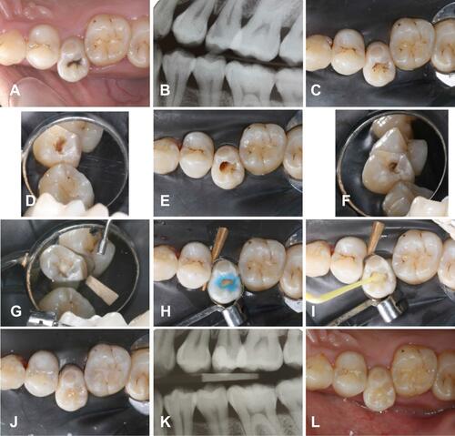 Figure 2 Steps of tunnel restoration in Tooth 15. (A) Occlusal view of 15 before operation; (B) Right bitewing radiography; (C) Occlusal view of the access to the mesial proximal caries; (D) Lateral view of the access to the mesial proximal caries; (E) Occlusal view of the cavity after caries removal; (F) Lateral view of the cavity after caries removal; (G) Restoration of the proximal wall of the cavity; (H) Selective acid-etching on enamel; (I) Bonding agents were applied to the cavity; (J) Restoration of the occlusal cavity; (K) Postoperative bitewing radiograph; (L) Occlusal view after three months.