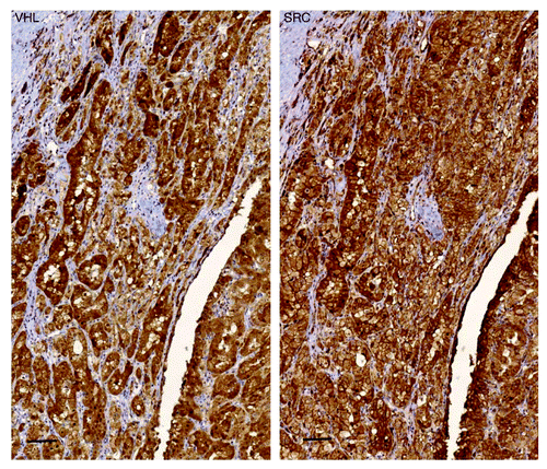 Figure 3. Primary Ki-CA patient tumor immunohistochemistry. Tumor exhibited both Src positivity (A) and VHL positivity (B). Power: 20 × ; Scale bar: 20 μM