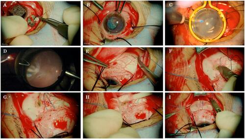 Figure 1 Intraoperative 2D snapshots of chandelier-assisted scleral buckling in case #16. All the images were pictured in the large monitor of the 3D visual system. (A) Following conjunctival peritomy around the limbus and isolation of the rectus muscles with 4–0 silk, a chandelier illumination fiber was placed 4.0 mm behind the limbus at the quadrant opposite the breaks. (B) An anti-drying contact lens was positioned on top of the cornea covered with viscoelastic material. (C) The wide-angle viewing system was activated. (D) Cryopexy was applied to the retinal breaks. With pilot diathermy, flecks applied prior to the chandelier setting were observed. (E) After the light fiber was removed, 5–0 Dacron sutures were applied for the buckle under a microscope with high magnification. (F) Sclerotomy for the external drainage site was also made under a microscope with high magnification. (G) Puncture of the uvea was carried out by a single application of an endolaser. (H) External drainage of subretinal fluid was carried out by scleral depression. (I) The silicone tire was explanted.