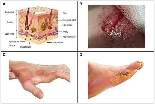 Figure 1 Schematic diagram of skin structure (A), physical trauma (B), chemical trauma (C) and pathological trauma (D).