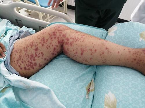 Figure 1 Clinical image of diffuse palpable purpura on the left leg in a COVID-19 confirmed case. The 23 years old male patient had confirmed COVID-19 infection. Erythema with dry cough were the initial symptoms which quickly followed by fever and shortness of breath.