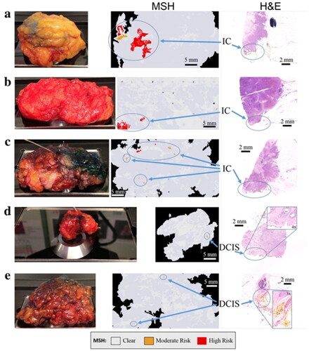 Figure 8. Examples of multi-modal spectral histopathology (MSH) measurements of whole breast conserving surgery (BCS) specimens with positive margins confirmed by histopathological assessment. The surface measured by MSH is facing downward in the specimen images. MSH detected tumor on the surface of all specimens in 12–24 min. (a–c) invasive carcinoma (IC); (d,e) ductal carcinoma in situ (DCIS). Reprinted with permission from [Citation112]. Copyright [2018] Springer nature.