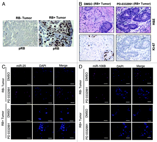 Figure 2. MicroRNA 106b-cluster analysis in human breast tumor explants treated with PD 0332991. (A) Immunohistochemical localization of pRB in RB- and RB+ human breast tumors. (B) H&E and ki67 staining in RB+ human solid breast tumors. (C) In situ hybridization detection of miR25 in RB- and RB+ human breast tumors. (D) In situ hybridization detection of miR106b. (n = 11 ER+RB+ tumors and 2 ER-RB- tumors.)