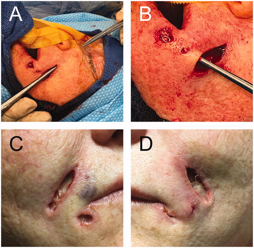 Figure 3. A and B. Intraoperative images showing the communication between nearby lesions and extension up to the infraorbital rim. C and D. Postoperative wounds that healed with regular dressing by secondary intention.