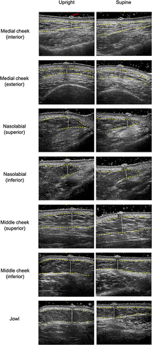 Figure 8 Ultrasound images of a 55-year-old volunteer depicting the increase in fat thickness from upright to supine at the interior and exterior medial cheek and superior middle cheek compartments and a decrease in the superior and inferior nasolabial, inferior middle cheek, and jowl compartment points. Yellow dashed lines represent upper and lower borders of superficial facial fat; white vertical lines represent thickness of superficial facial fat; red arrow points at metallic decal at point of measurement.