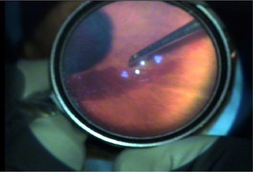 Figure 2 Intrectomy was performed under visualization with an indirect ophthalmoscope using a 20 diopter lens, without the aid of a microscope.