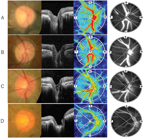 Figure 2. Representative ONH of RP patients with (A, B) and without (C, D) waxy pallor appearance of the ONH, and with (A, C) and without (B, D) a hyper-reflective structure on the ONH.ONH, optic nerve head; RP, retinitis pigmentosa.