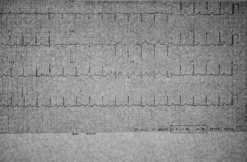 Fig. 2. ECG at 12 hours showing resolution of ST segment depression.
