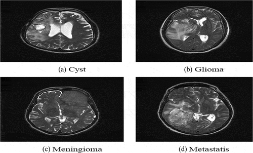 Figure 1. Sample Images of Four Brain Tumor Types.