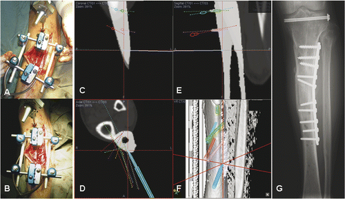 Figure 6. After placing a patient tracker on the proximal tibia and performing image-to-patient registration, proximal and distal alignments pins were inserted into the corresponding tibial segments under navigational guidance (A). The plane of the tibial osteotomy was identified and marked according to the navigation planning, and the osteotomy performed using an oscillating saw. The distal tibial segment was then realigned until the proximal and distal alignment pins were parallel and stabilized with an external fixator (B). A navigation probe was run along the surface of the realigned distal tibia, and the tip of the probe matched with the bone surface of the realigned tibia in the virtual navigation plan in the coronal (C), axial (D) and sagittal (E) images, thereby indirectly navigating and confirming the final corrected position of the distal tibial segment. The reconstructed 3D tibia model (F) was less useful for this validation because the CT Spine Navigation software was unable to segment and display the virtual distal tibia with the corrected position. A postoperative plain radiograph of the tibia showed satisfactory alignment and a healed osteotomy at 5 months following surgery (G).