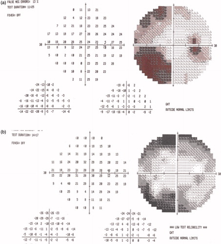 Figure 1. (a) There was peripheral depression on the right visual field test. (b) The postoperative right visual field test was lighter than at first.