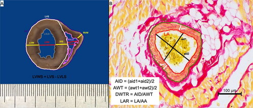Figure 1. The methods of gross pathological and histological morphometrical analysis. (A) The methodology of the gross measurements of the studied hearts that were conducted on the transverse section of the ventricular wall at the level of the upper third of the ventricle (below the valvular ring). (B) The methodology of the histological morphometric measurements of intramyocardial coronary arteries as proposed by Falk et al. (Citation2006); picro sirius red stain, 200× magnification. AA: arterial area; aid: measured arterial internal diameter; AID: calculated arterial internal diameter; awt: measured arterial wall thickness; AWT: calculated arterial wall thickness; DWTR: arterial diameter-to-wall thickness ratio; HS: heart surface; IVS: interventricular septum; LAR: arterial lumen-to-area ratio; LVID: left ventricular internal diameter; LVLS: left ventricular lumen surface; LVS: left ventricular surface; LVW: left ventricular wall; LVWS: left ventricular wall surface; RVID: right ventricular internal diameter; RVLS: right ventricular lumen surface; RVW: right ventricular wall.