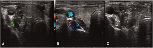 Figure 4. Images from a 29-year-old female diagnosed with severe SHPT. (A) Before MWA, a liquid insulation layer (the arrow head) was created to protect the adjacent recurrent laryngeal nerves and vessels from thermal injury. The size of the parathyroid gland at the superior right position detected by ultrasound was 1.7*1.3*0.6 cm. (B) Color Doppler image showed abundant blood flows in the gland before MWA. (C) After MWA，the local echo of the nodule was not uniform when detected by ultrasound. SHPT : secondary hyperparathyroidism.