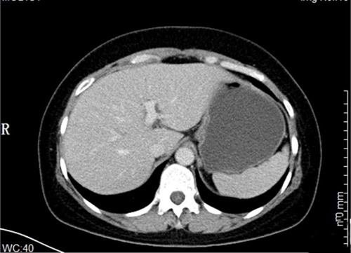 Figure 2 Abdominal CT examination showed the occupying lesion of the lesser curvature of gastric antrum (size 3.6×2.8 cm).