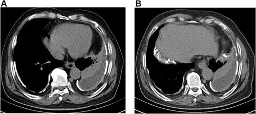 Figure 3 Mediastinal windows of computed tomography (A and B) revealed pleural effusion on the left side.