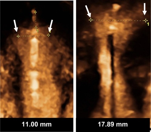 Figure 4 3-D ultrasound of GyneFix® 200 IUD (Contrel Research, Ghent, Belgium) (left), illustrating the compatibility of the frameless IUD and frameless LNG-IUS (right) with very narrow uterine cavities of young adolescent and nulliparous women.