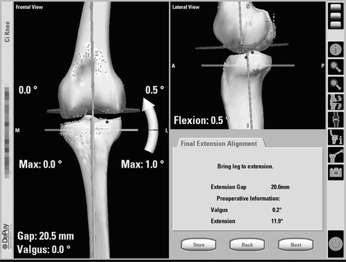 Figure 1. Ligament balancing mode with visualization of leg axis, gap size and medio-lateral instability (BrainLAB®). [Color version available online]