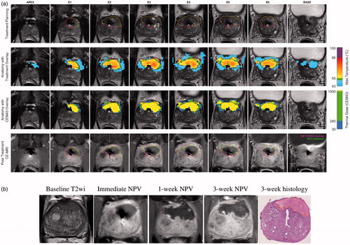 Figure 2. Lesion-targeted TULSA treatment (a) and 3-week follow-up (b) for patient number 2. (a) Intra-procedural MR images, with immediate post-treatment contrast-enhanced overlay images from active elements showing high spatial concordance between target volume (top row), 55 °C isotherm volume (cytocidal temperature, second row), thermal dose coverage (third row), and non-perfused-volume (NPV, fourth row). (b) Baseline imaging identified an anterior 3 cc PIRADS 5 lesion with a biopsy-concordant high-volume Gleason 3 + 3 PCa (MRI-TBx 4/4 positive cores, systematic biopsies 6 + 6 negative). Post-treatment, 1- and 3-week NPV and 3-week whole-mount hematoxylin-eosin-stained slide demonstrate high volumetric and morphometric concordance. Note that complete necrosis reached the capsule and thermal damage was well-confined. NPV covered the entire PIRADS 5 lesion and no vital cancerous tissue was reported in the vicinity of the targeted lesion. In final histopathology of the whole prostate specimen, only a posteroapical MRI-negative microfocus of vital histologically insignificant Gleason pattern 3 PCa was detected.