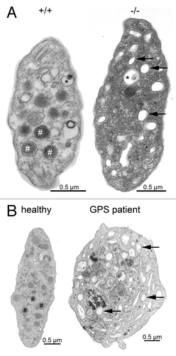 Figure 1. Platelet ultrastructure in Nbeal2−/− mice (A) and human GPS (B). Representative transmission electron microscopy (TEM) images of resting wild-type (+/+) and Nbeal2−/− (−/−) platelets and those of a control human subject as well as a characterized GPS patientCitation9,Citation15 with a homozygous L388P mutation. Platelets deficient in NBEAL2 both show lack of α-granules (#) and an increased number of vacuoles (arrows) while platelet size was increased and dense granule (*) content was unaltered. Bars = 0.5 µm.