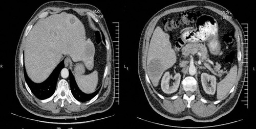 Figure 2 (A, B) Scattered metastatic hypodense lesions in liver.