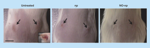 Figure 4.  Methicillin-resistant Staphylococcus aureus-infected murine abscesses: untreated, treated with empty nanoparticles, and treated with nitric oxide nanoparticles at day 4.Arrows denote abscesses. Inset: representative purulent abscess 4 days post-methicillin-resistant Staphylococcus aureus infection. Scale bar: 5 mm.NO: Nitric oxide; np: Nanoparticle.Reproduced with permission from [Citation49]. © Han et al. (2009).