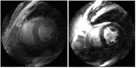Figure 1. Real-time, GRE (left) and Triggered SSFP (right) single frames of approximately the same mid-ventricular location.