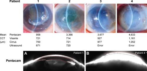 Figure 4 Central corneal thickness measurements in each grade of corneal edema and anterior-segment photos obtained using the Pentacam with inexact anterior and posterior corneal alignment.