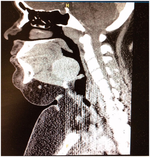 Figure 2. Sagittal view of the head and neck CT image.