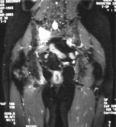 Figure 2. MRI scan illustrating a typical fracture of the sacral wing on ipsilateral side of the ramus fracture.