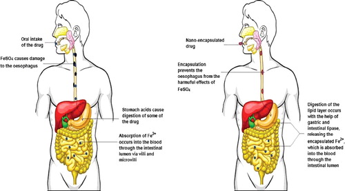 Figure 3. A pictorial representation of the intake of Fe2+ drugs, non-encapsulated and nano-encapsulated, and their effect on the gastrointestinal tract. Conventional drugs containing iron salts (left panel) have a damaging effect on the gastrointestinal tract. Some of the drugs are acted upon by the gastric juices, which reduces the drug bioavailability of. Encapsulation of the drug in a lipid nanostructure (right panel) saves the gastrointestinal tract from the harsh effects of the drug and also increases the bioavailability of the drugs.
