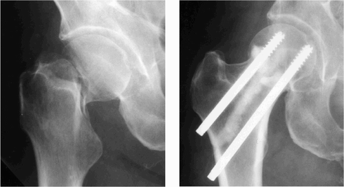 Displaced femoral neck fracture before (left) and after (right) internal fixation with cannulated screws and calcium phosphate for augmentation.