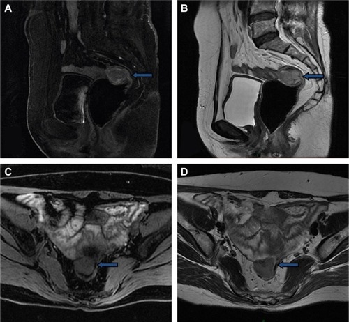 Figure 2 Pelvic magnetic resonance imaging showed that a 3.1×2.6 cm2 nodule (blue arrows) had invaded the rectum.