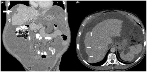 Figure 3. CT coronal (A) and axial (B) sections with pseudomyxoma peritonei showing scalloping of the liver surface (arrows).
