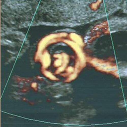Figure 3 Umbilical cord entanglement of monochorionic diamniotic twins following spontaneous antepartum septostomy of the intervening membrane, sonographically mimicking a true knot of the umbilical cord.Note: Reproduced with permission from Sherer DM, Bitton C, Stimphil R, et al. Cord entanglement of monochorionic diamniotic twins following spontaneous antepartum septostomy sonographically simulating a true knot of the umbilical cord. Ultrasound Obstet Gynecol. 2005;26(6):676–678.17. Copyright © 2005 ISUOG. Published by John Wiley & Sons, Ltd.Citation17
