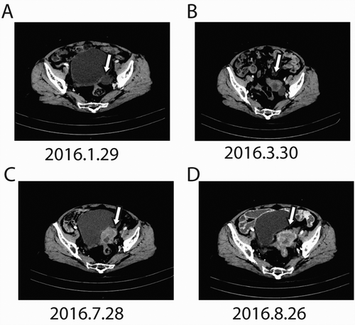 Figure 1. CT scan before apatinib treatment (the lesions are indicated by arrows). A. CT scans before Apatinib therapy revealed disease progress in the Vaginal stump; B. after four cycles of gemcitabine, the metastatic mass became bigger; C. after three cycles of paclitaxel plus nedaplatin, the metastatic mass was still bigger; D. after oneone cycle of topotecan plus endostar, the metastatic mass continue to be bigger.