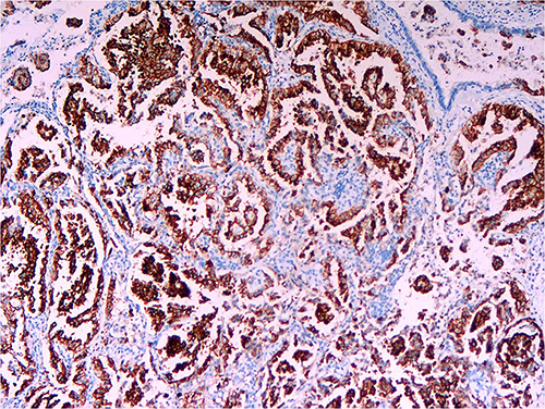 Figure 1 Immunohistochemical staining by D5F3 (Ventana, Oro Valley, Arizona) shows diffuse expression of ALK in the cytoplasm of tumor cells (original magnification ×100).
